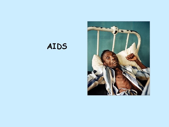 AIDS 