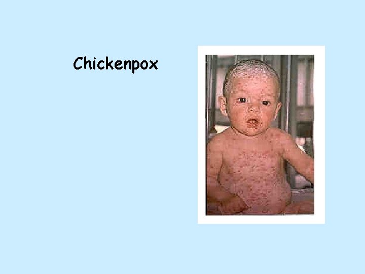 Chickenpox 