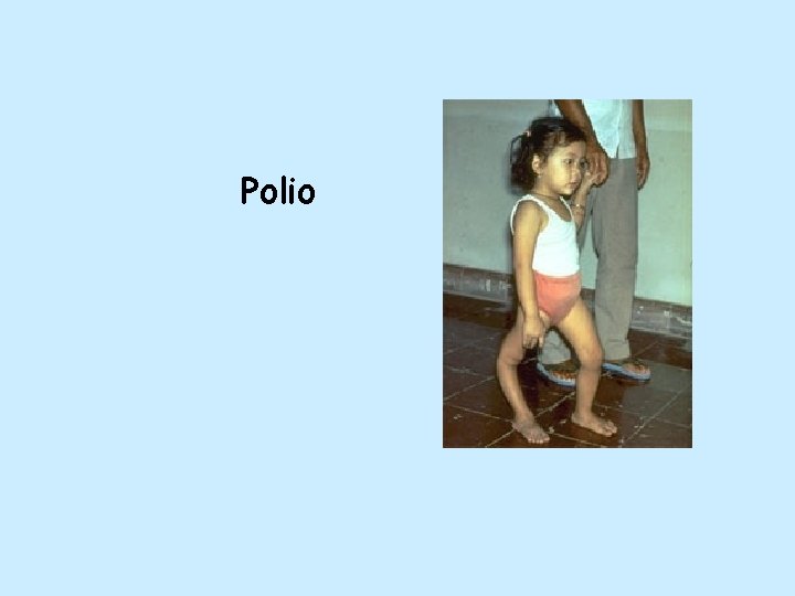 Polio 