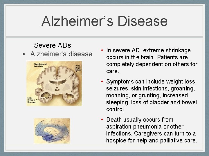 Alzheimer’s Disease Severe ADs • Alzheimer’s disease • In severe AD, extreme shrinkage occurs