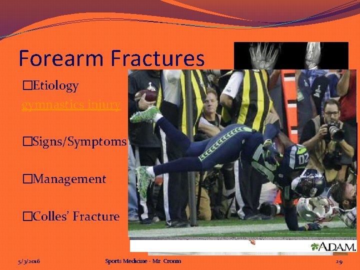 Forearm Fractures �Etiology gymnastics injury �Signs/Symptoms �Management �Colles’ Fracture 5/3/2016 Sports Medicine - Mr.