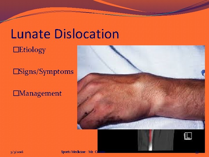 Lunate Dislocation �Etiology �Signs/Symptoms �Management 5/3/2016 Sports Medicine - Mr. Cronin 53 