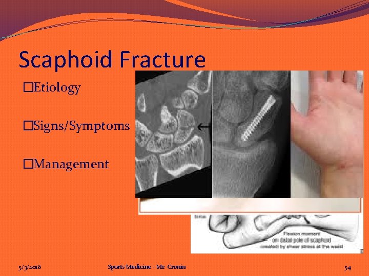 Scaphoid Fracture �Etiology �Signs/Symptoms �Management 5/3/2016 Sports Medicine - Mr. Cronin 54 