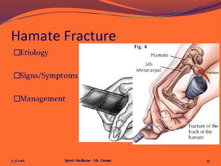 Hamate Fracture �Etiology �Signs/Symptoms �Management 5/3/2016 Sports Medicine - Mr. Cronin 55 Hamate Fracture �Etiology �Signs/Symptoms �Management 5/3/2016 Sports Medicine - Mr. Cronin 55