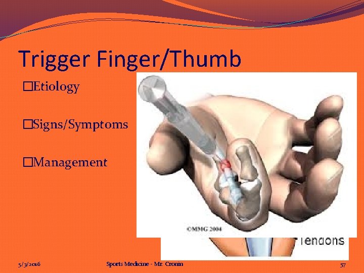 Trigger Finger/Thumb �Etiology �Signs/Symptoms �Management 5/3/2016 Sports Medicine - Mr. Cronin 57 