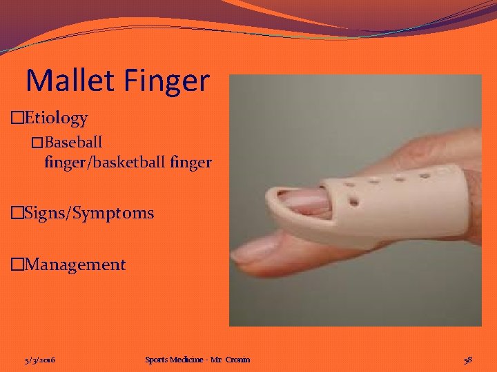 Mallet Finger �Etiology �Baseball finger/basketball finger �Signs/Symptoms �Management 5/3/2016 Sports Medicine - Mr. Cronin Mallet Finger �Etiology �Baseball finger/basketball finger �Signs/Symptoms �Management 5/3/2016 Sports Medicine - Mr. Cronin