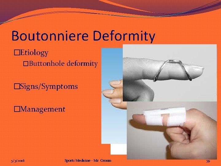 Boutonniere Deformity �Etiology �Buttonhole deformity �Signs/Symptoms �Management 5/3/2016 Sports Medicine - Mr. Cronin 59