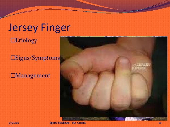 Jersey Finger �Etiology �Signs/Symptoms �Management 5/3/2016 Sports Medicine - Mr. Cronin 60 