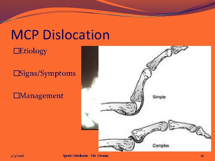 MCP Dislocation �Etiology �Signs/Symptoms �Management 5/3/2016 Sports Medicine - Mr. Cronin 62 