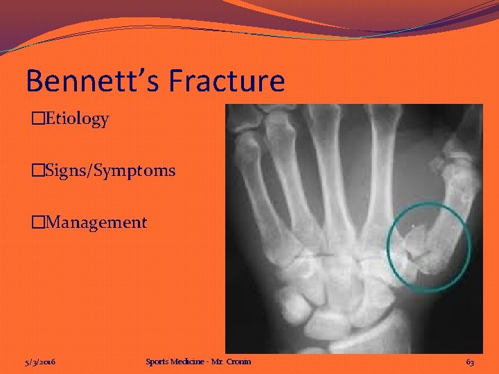 Bennett’s Fracture �Etiology �Signs/Symptoms �Management 5/3/2016 Sports Medicine - Mr. Cronin 63 