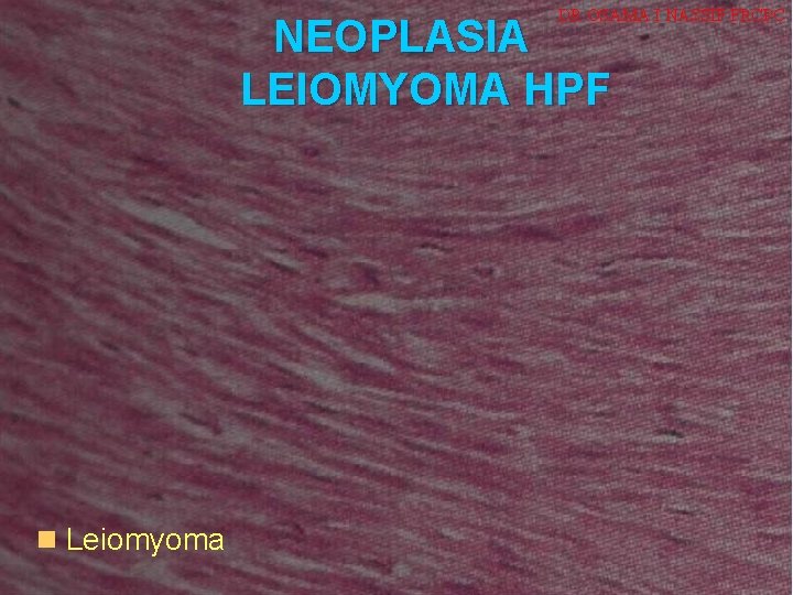 NEOPLASIA n Leiomyoma Dr. Osama I Nassif. MD, FRCPC. DR OSAMA I NASSIF FRCPC
