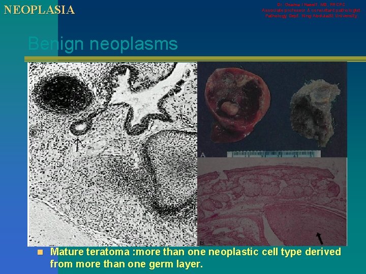 NEOPLASIA Dr. Osama I Nassif. MD, FRCPC. Associate professor & consultant pathologist. Pathology Dept.