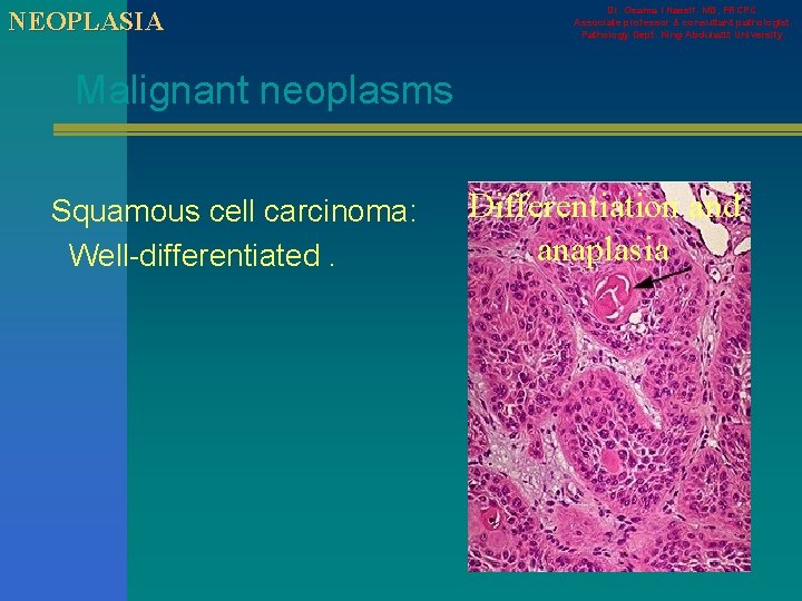 NEOPLASIA Dr. Osama I Nassif. MD, FRCPC. Associate professor & consultant pathologist. Pathology Dept.