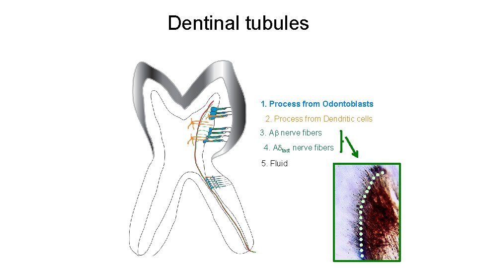 Dentinal tubules 1. Process from Odontoblasts 2. Process from Dendritic cells 3. A nerve