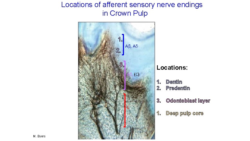 Locations of afferent sensory nerve endings in Crown Pulp 1. 2. A , A