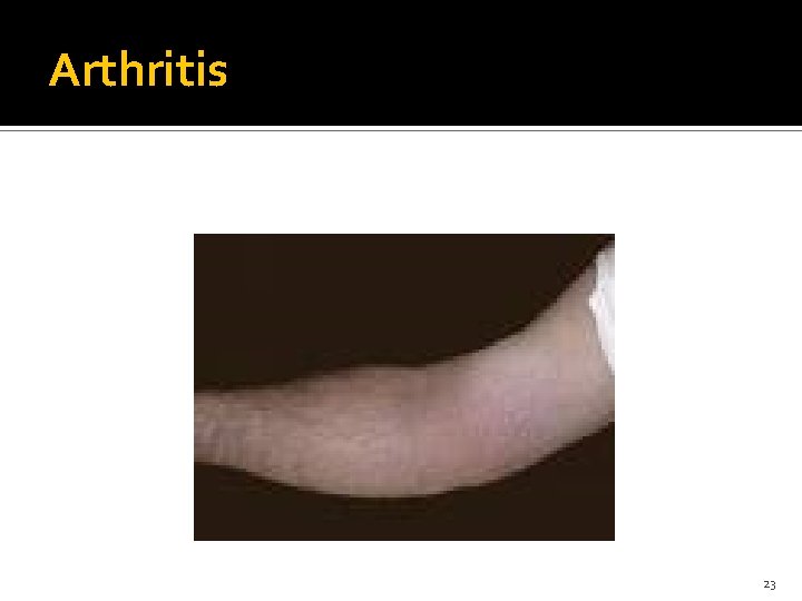 Arthritis 23 