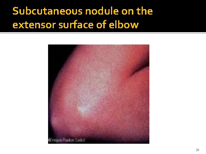 Subcutaneous nodule on the extensor surface of elbow 32 