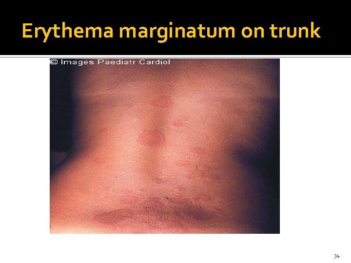 Erythema marginatum on trunk 34 