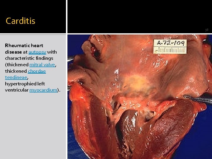 Carditis 38 Rheumatic heart disease at autopsy with characteristic findings (thickened mitral valve, thickened