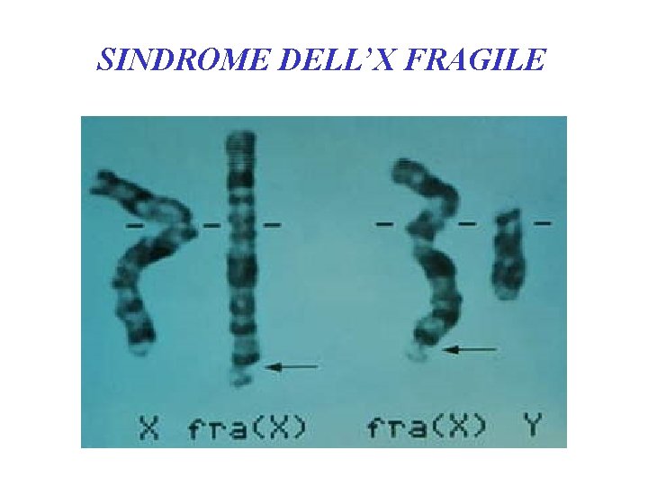 SINDROME DELL’X FRAGILE 