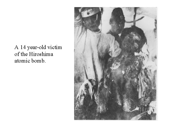 A 14 year-old victim of the Hiroshima atomic bomb. 