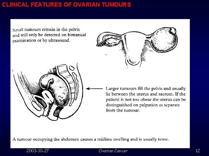 CLINICAL FEATURES OF OVARIAN TUMOURS 2003 -10 -27 Ovarian Cancer 12 