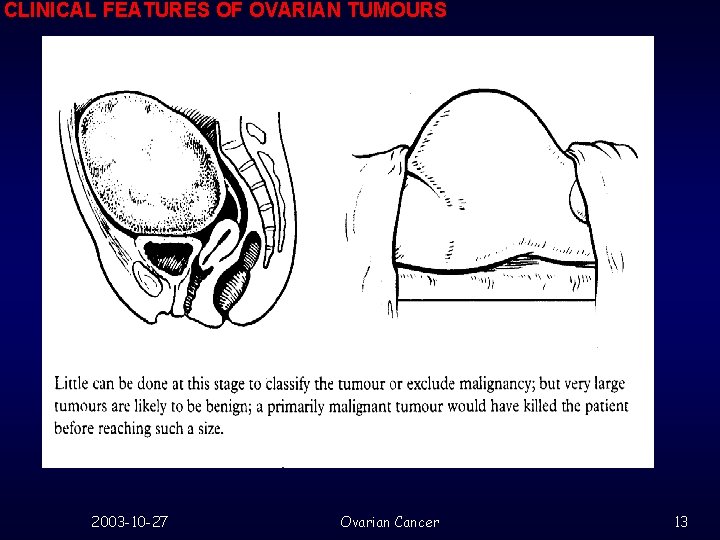 CLINICAL FEATURES OF OVARIAN TUMOURS 2003 -10 -27 Ovarian Cancer 13 