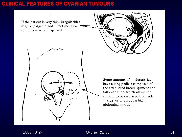 CLINICAL FEATURES OF OVARIAN TUMOURS 2003 -10 -27 Ovarian Cancer 14 