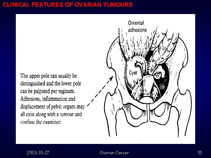 CLINICAL FEATURES OF OVARIAN TUMOURS 2003 -10 -27 Ovarian Cancer 15 