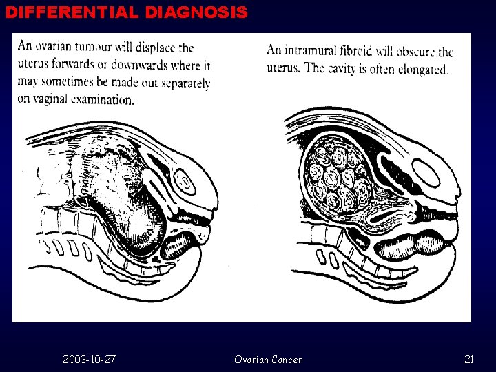 DIFFERENTIAL DIAGNOSIS 2003 -10 -27 Ovarian Cancer 21 