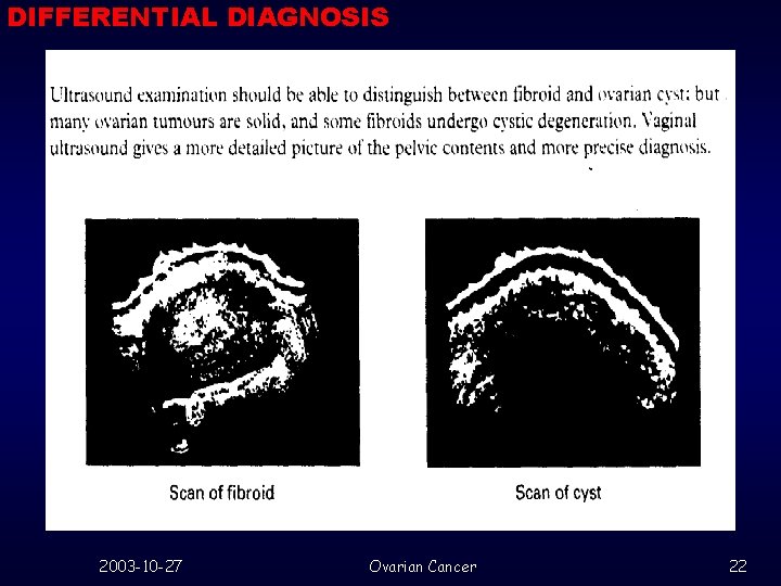 DIFFERENTIAL DIAGNOSIS 2003 -10 -27 Ovarian Cancer 22 
