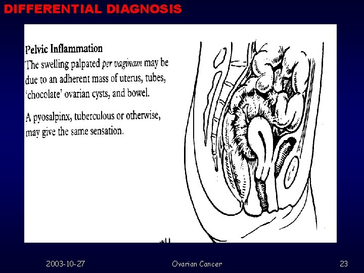 DIFFERENTIAL DIAGNOSIS 2003 -10 -27 Ovarian Cancer 23 