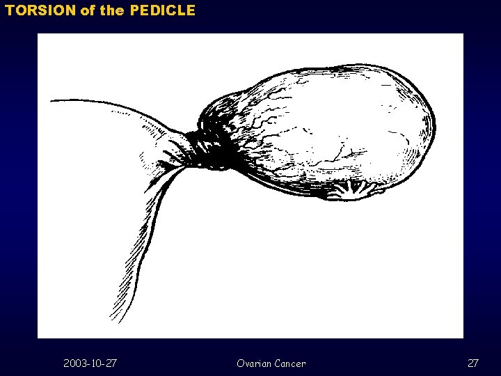 TORSION of the PEDICLE 2003 -10 -27 Ovarian Cancer 27 