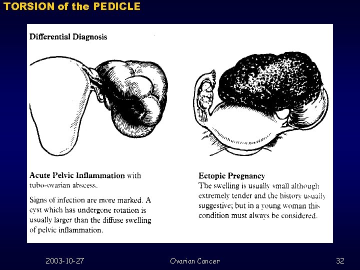 TORSION of the PEDICLE 2003 -10 -27 Ovarian Cancer 32 