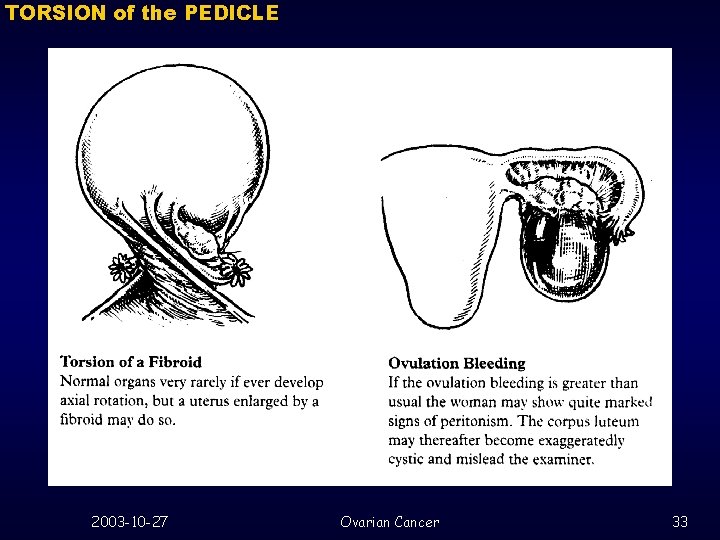 TORSION of the PEDICLE 2003 -10 -27 Ovarian Cancer 33 