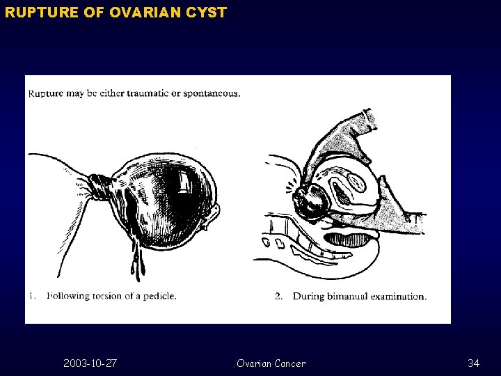 RUPTURE OF OVARIAN CYST 2003 -10 -27 Ovarian Cancer 34 