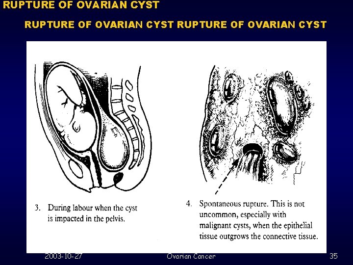 RUPTURE OF OVARIAN CYST 2003 -10 -27 Ovarian Cancer 35 