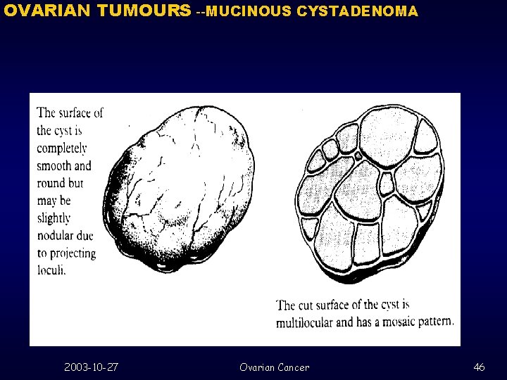 OVARIAN TUMOURS --MUCINOUS CYSTADENOMA 2003 -10 -27 Ovarian Cancer 46 