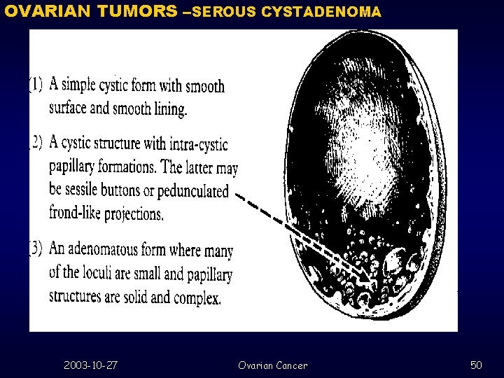 OVARIAN TUMORS --SEROUS CYSTADENOMA 2003 -10 -27 Ovarian Cancer 50 