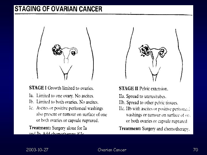 2003 -10 -27 Ovarian Cancer 70 