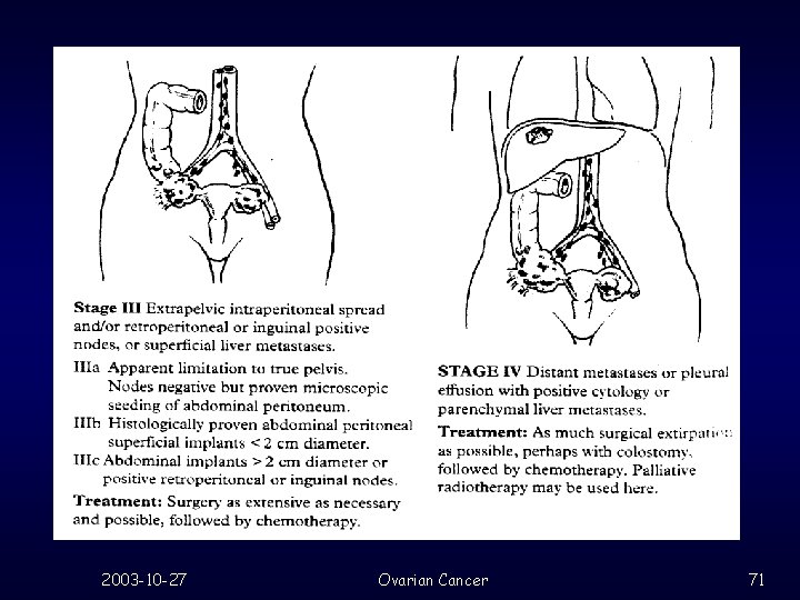 2003 -10 -27 Ovarian Cancer 71 