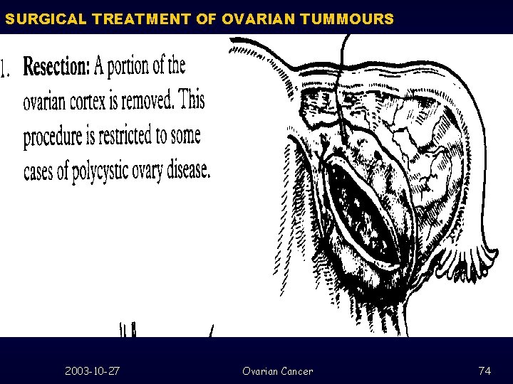 SURGICAL TREATMENT OF OVARIAN TUMMOURS 2003 -10 -27 Ovarian Cancer 74 