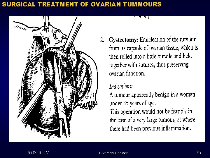 SURGICAL TREATMENT OF OVARIAN TUMMOURS 2003 -10 -27 Ovarian Cancer 75 