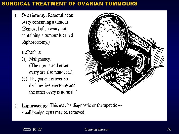 SURGICAL TREATMENT OF OVARIAN TUMMOURS 2003 -10 -27 Ovarian Cancer 76 