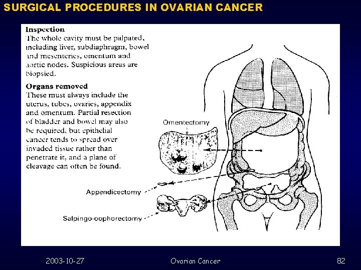 SURGICAL PROCEDURES IN OVARIAN CANCER 2003 -10 -27 Ovarian Cancer 82 