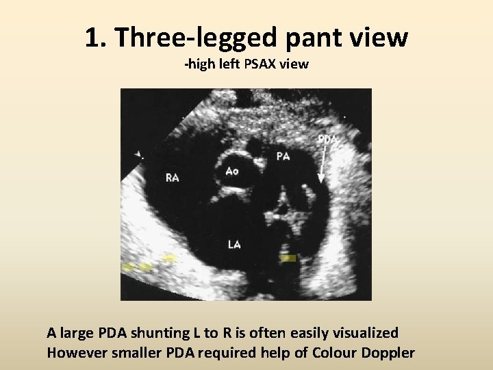 1. Three-legged pant view -high left PSAX view A large PDA shunting L to