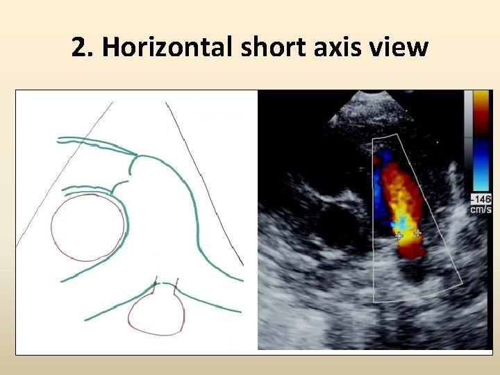 2. Horizontal short axis view 