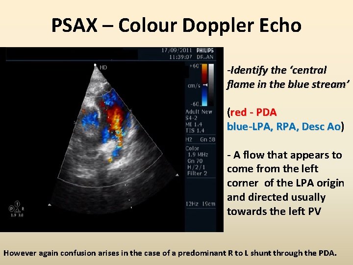 PSAX – Colour Doppler Echo -Identify the ‘central flame in the blue stream’ (red