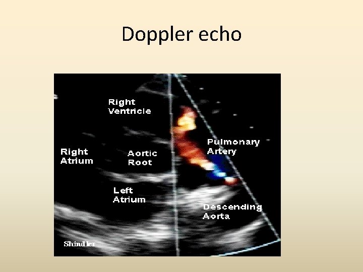 Doppler echo 