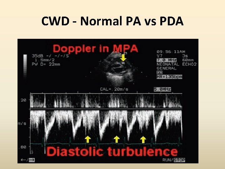 CWD - Normal PA vs PDA 